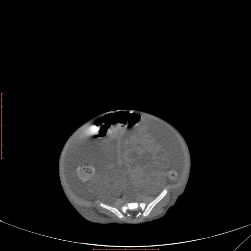 Autosomal recessive polycystic kidney disease associated with Caroli disease (Radiopaedia 61932-69984 Axial non-contrast 278).jpg