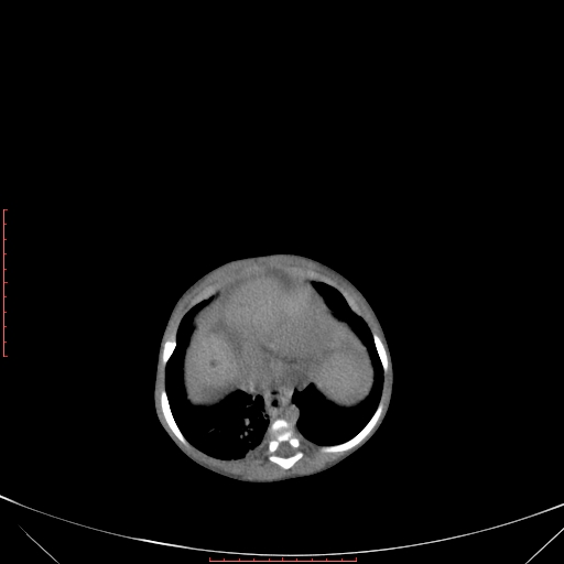 Autosomal recessive polycystic kidney disease associated with Caroli disease (Radiopaedia 61932-69984 Axial non-contrast 98).jpg