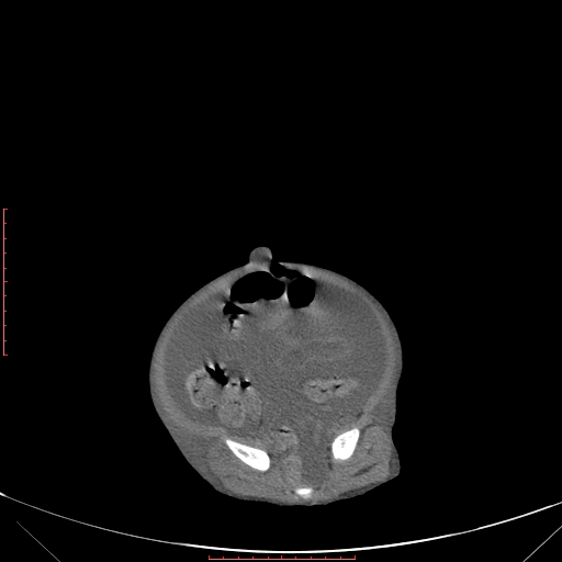 Autosomal recessive polycystic kidney disease associated with Caroli disease (Radiopaedia 61932-69984 B 310).jpg