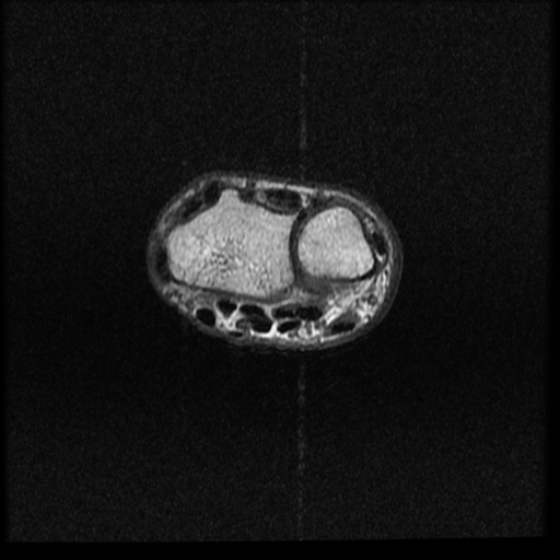 File:Avascular necrosis - scaphoid non-union (Radiopaedia 63457-72065 Axial T1 17).jpg