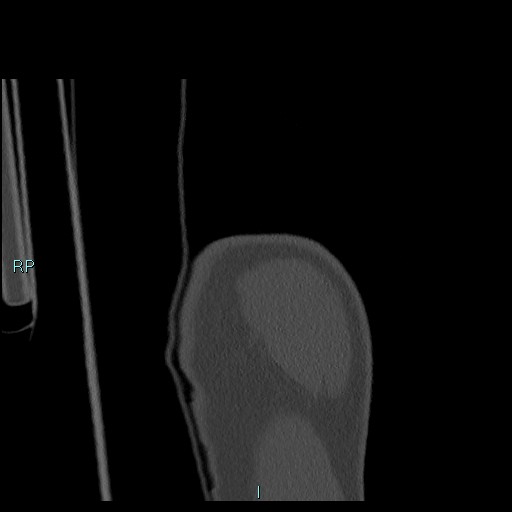 Avascular necrosis after fracture dislocations of the proximal humerus (Radiopaedia 88078-104655 Coronal bone window 17).jpg