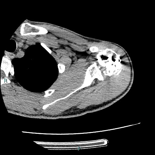 Avascular necrosis after fracture dislocations of the proximal humerus (Radiopaedia 88078-104655 D 44).jpg