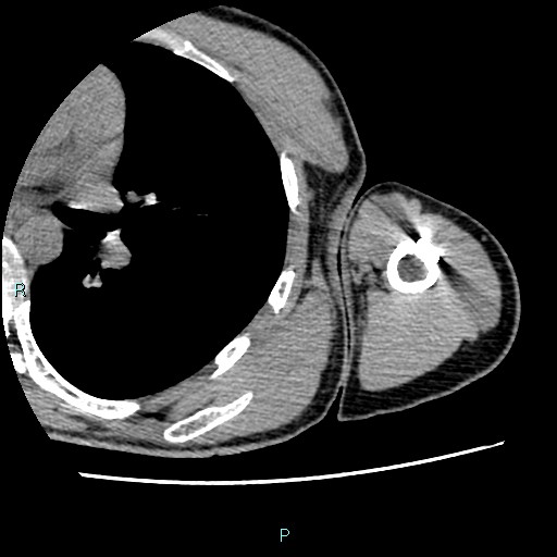 File:Avascular necrosis after fracture dislocations of the proximal humerus (Radiopaedia 88078-104655 D 90).jpg