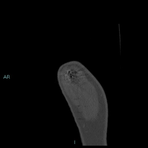 Avascular necrosis after fracture dislocations of the proximal humerus (Radiopaedia 88078-104655 Sagittal bone window 3).jpg