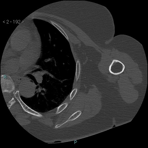 Avascular necrosis of the shoulder - Cruess stage I (Radiopaedia 77674-89887 Axial bone window 48).jpg