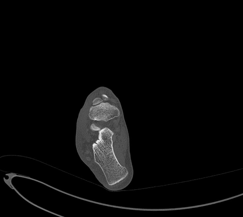 Avulsion fractures of talus and calcaneus (Radiopaedia 48277-53155 Axial bone window 63).jpg