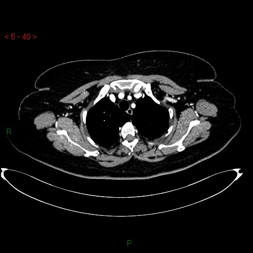 Azygos fissure and lobe (Radiopaedia 47620-52278 A 26).jpg