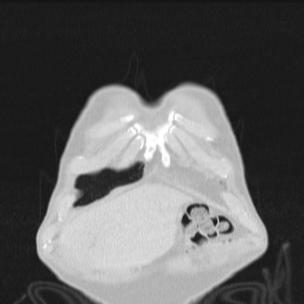 Azygos lobe (Radiopaedia 38259-40275 Coronal lung window 8).jpg