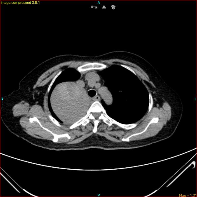 Azygos vein aneurysm (Radiopaedia 77824-90130 A 16).jpg