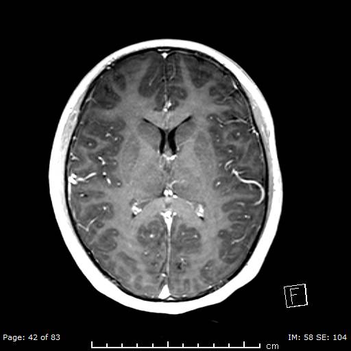 File:Balo concentric sclerosis (Radiopaedia 61637-69636 Axial T1 C+ 42).jpg