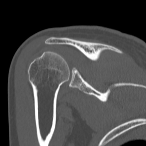 Bankart lesion (Radiopaedia 57256-64185 Coronal bone window 32).jpg