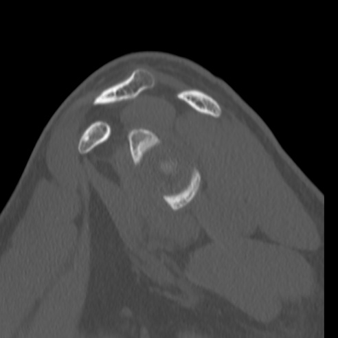 Bankart lesion (Radiopaedia 57256-64185 Sagittal bone window 28).jpg