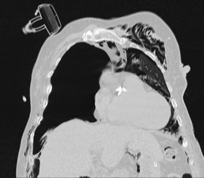 Barotrauma due to mechanical ventilation (Radiopaedia 28079-28336 Coronal lung window 32).jpg