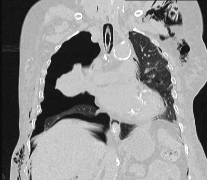 Barotrauma due to mechanical ventilation (Radiopaedia 28079-28336 Coronal lung window 50).jpg