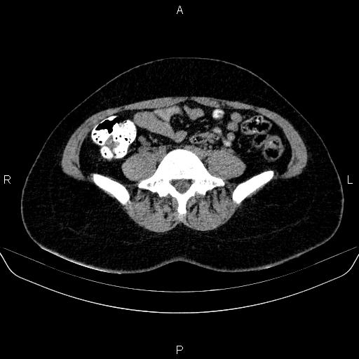 Bartholin gland cyst (Radiopaedia 62635-70930 Axial non-contrast 4).jpg