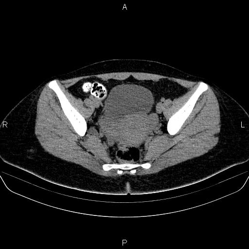 Bartholin gland cyst (Radiopaedia 62635-70930 Axial non-contrast 44).jpg