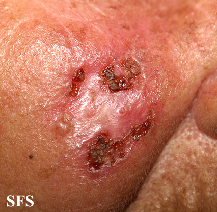 Basal Cell Carcinoma (Dermatology Atlas 154).jpg