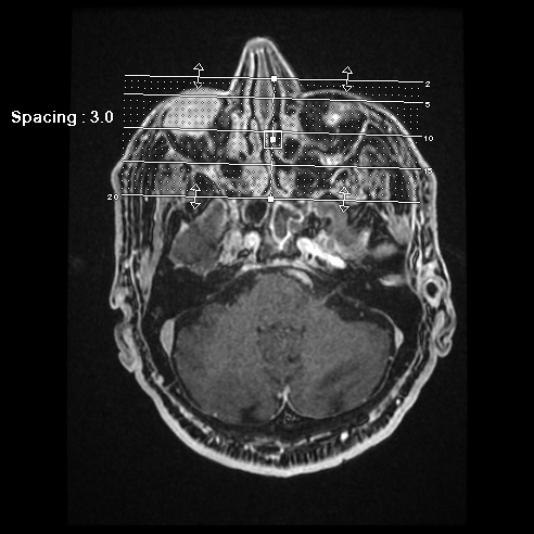 File:Basal cell carcinoma (periorbital) (Radiopaedia 55179-61559 E 1).jpg