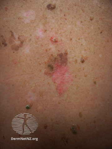 File:Basal cell carcinoma affecting the trunk (DermNet NZ lesions-bcc-trunk-0756).jpg