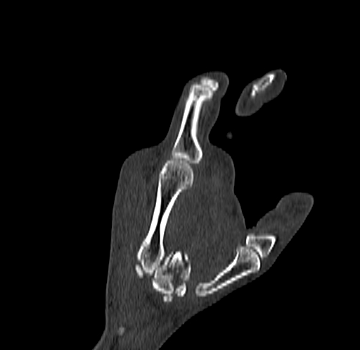 Base of 2nd metacarpal fracture (Radiopaedia 73741-84544 Coronal bone window 61).jpg