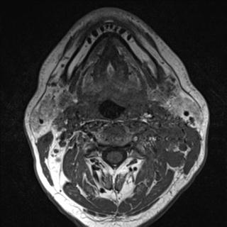 File:Base of tongue squamous cell carcinoma (Radiopaedia 31174-31884 Axial T1 19).jpg