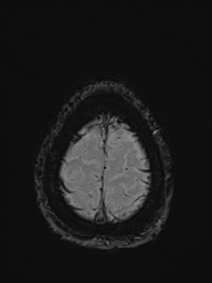 File:Basilar artery perforator aneurysm (Radiopaedia 82455-97733 Axial SWI 57).jpg
