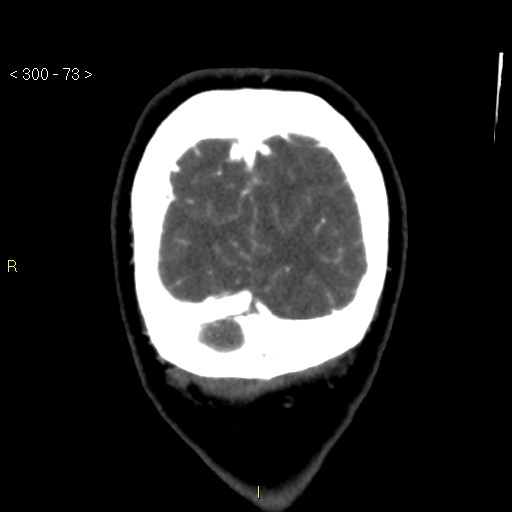 File:Basilar artery thrombosis (Radiopaedia 16260-15944 B 64).jpg