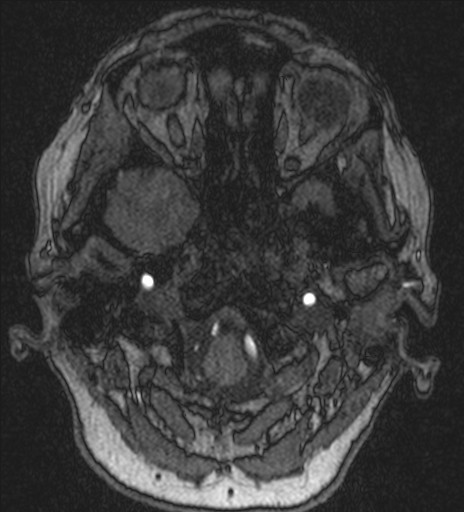 Basilar tip aneurysm (Radiopaedia 26504-26632 MRA 25).jpg