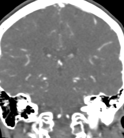 Basilar tip aneurysm with coiling (Radiopaedia 53912-60086 B 92).jpg