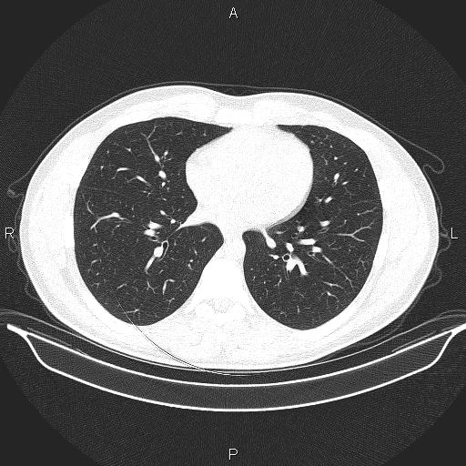 Beam hardening and ring artifacts (Radiopaedia 85323-100915 Axial lung window 48).jpg