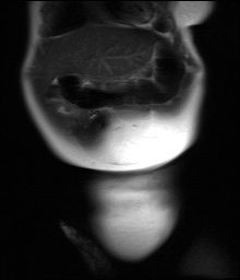 File:Beckwith-Wiedeman syndrome with bilateral Wilms tumors (Radiopaedia 60850-69233 Coronal T2 5).jpg