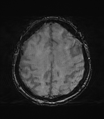 File:Behavioral variant frontotemporal dementia and late onset schizophrenia (Radiopaedia 52197-58083 Axial SWI 55).png