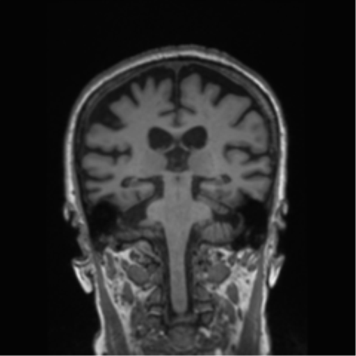 File:Behavioral variant frontotemporal dementia and late onset schizophrenia (Radiopaedia 52197-58083 Coronal T1 42).png