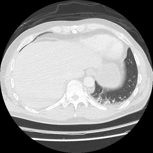 Benign post-traumatic pseudopneumoperitoneum (Radiopaedia 71199-81495 Axial lung window 59).jpg