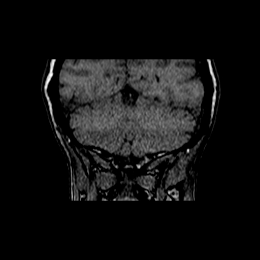File:Berry aneurysm of the terminal internal carotid artery (Radiopaedia 88286-104918 Coronal TOF 99).jpg