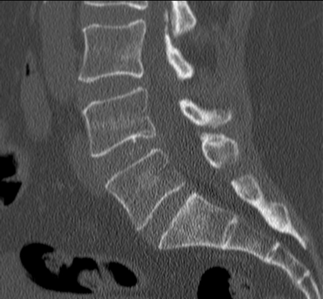 Bertolotti syndrome (Radiopaedia 24864-25128 Sagittal bone window 30).jpg