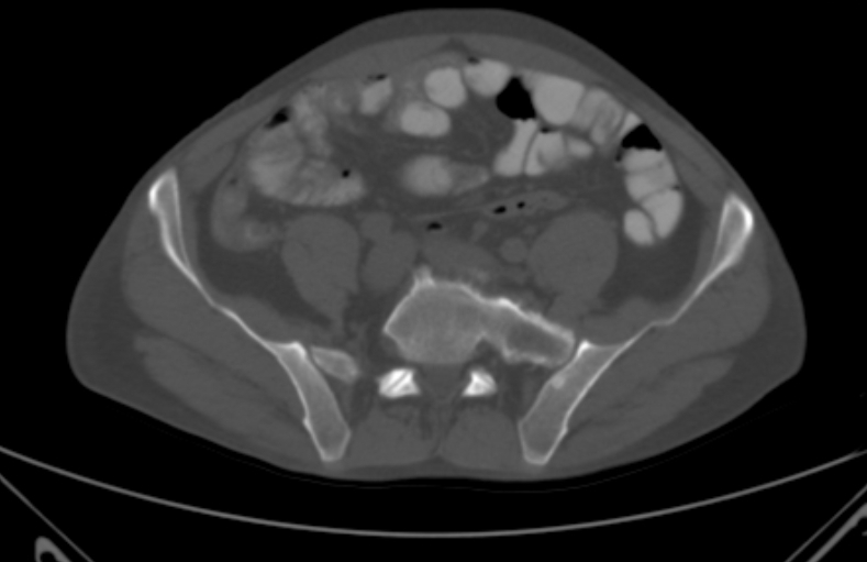 File:Bertolotti syndrome (Radiopaedia 58974-66235 Axial bone window 10).jpg