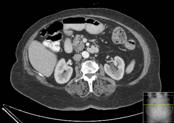 Bicameral celiacomesenteric aneurysm (Radiopaedia 55766-62327 A 26).jpg