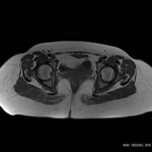 File:Bicornuate uterus- on MRI (Radiopaedia 49206-54297 Axial T1 12).jpg