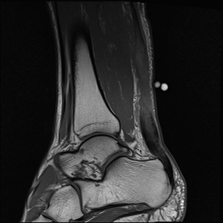 File:Bilateral Achilles tendon complete tear (Radiopaedia 81344-95051 Sagittal T1 24).jpg