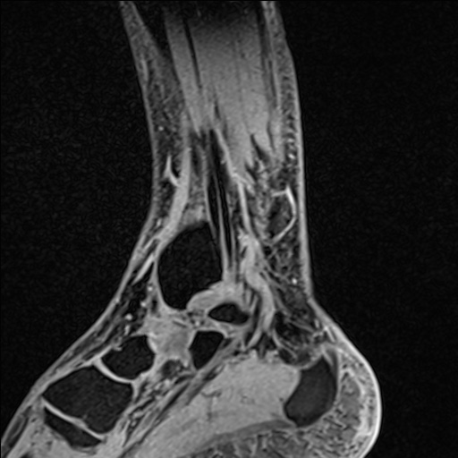 Bilateral Achilles tendon complete tear (Radiopaedia 81344-95051 Sagittal WE - Left 39).jpg