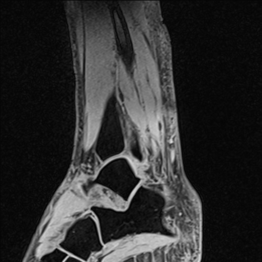 Bilateral Achilles tendon complete tear (Radiopaedia 81344-95051 Sagittal WE - Left 80).jpg