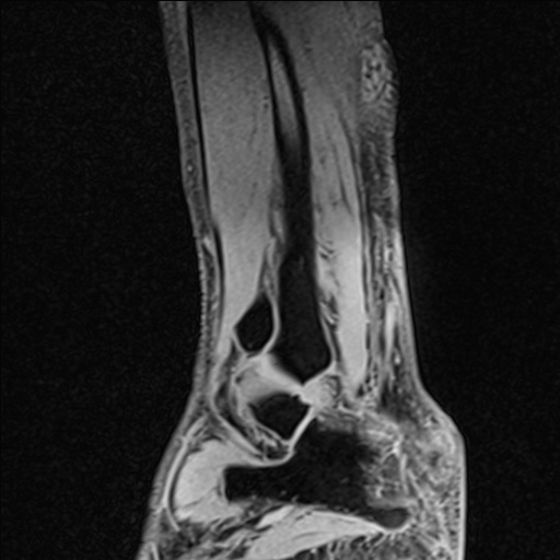 Bilateral Achilles tendon complete tear (Radiopaedia 81344-95051 Sagittal WE - Right 31).jpg