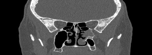 Bilateral Ectopic Infraorbital Nerves (Radiopaedia 49006-54084 Coronal bone window 54).jpg