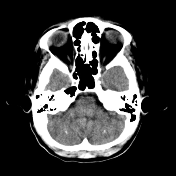 File:Bilateral PCA territory infarction - different ages (Radiopaedia 46200-50591 Axial non-contrast 4).jpg