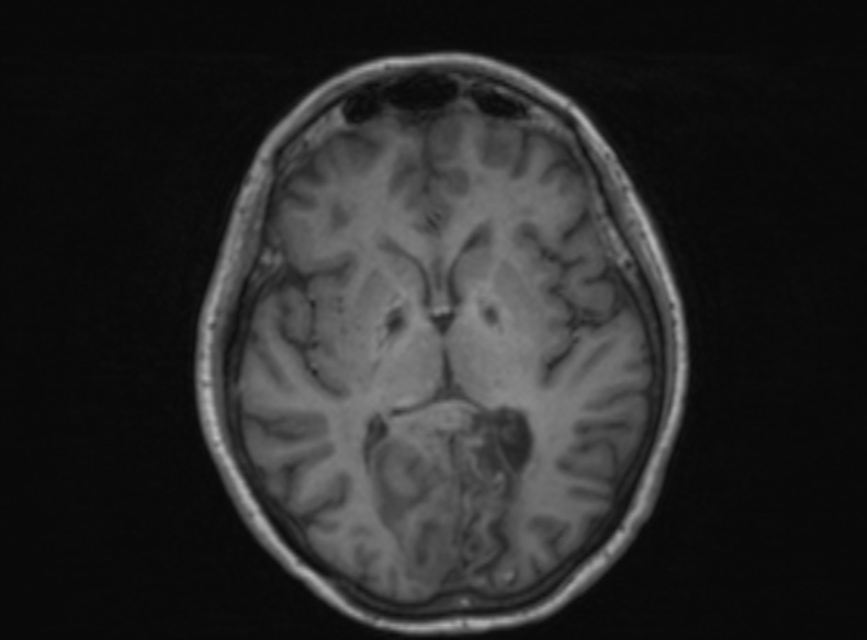 Bilateral PCA territory infarction - different ages (Radiopaedia 46200-51784 Axial T1 235).jpg