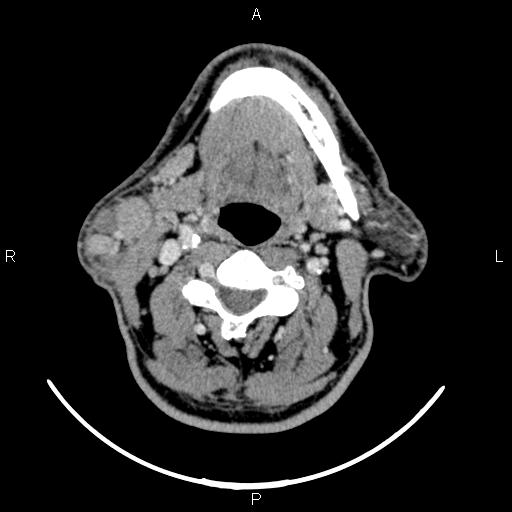Bilateral Warthin tumors (Radiopaedia 84034-99263 Axial With contrast 34).jpg