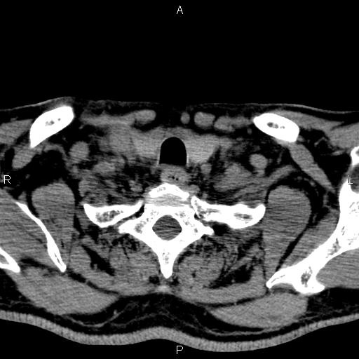 Bilateral Warthin tumors (Radiopaedia 84034-99263 Axial non-contrast 56).jpg