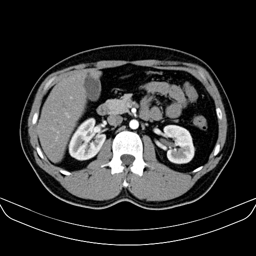 File:Bilateral accessory renal arteries with mild pelvi-ureteric junction (PUJ) obstruction (Radiopaedia 66357-75596 A 21).jpg