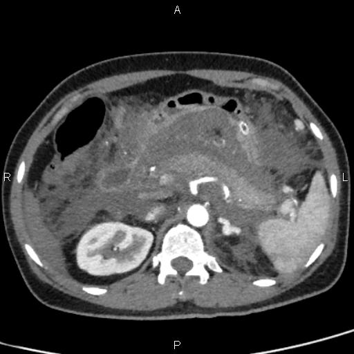 Bilateral adrenal gland hyperenhancement in pancreatitis (Radiopaedia 86642-102753 B 42).jpg